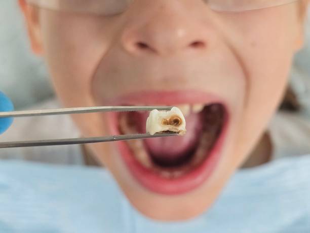 Best Emergency Treatment for Dental Infections or Abscesses in Trophy Clu, TX